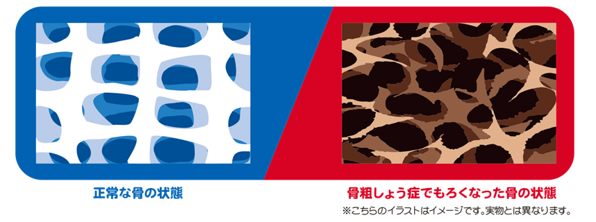 あなたの骨は大丈夫ですか?